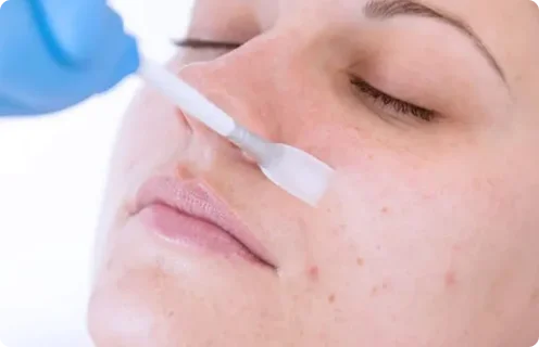 Chemical Peel